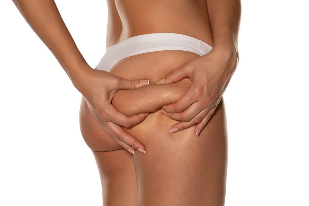 Donne e cellulite