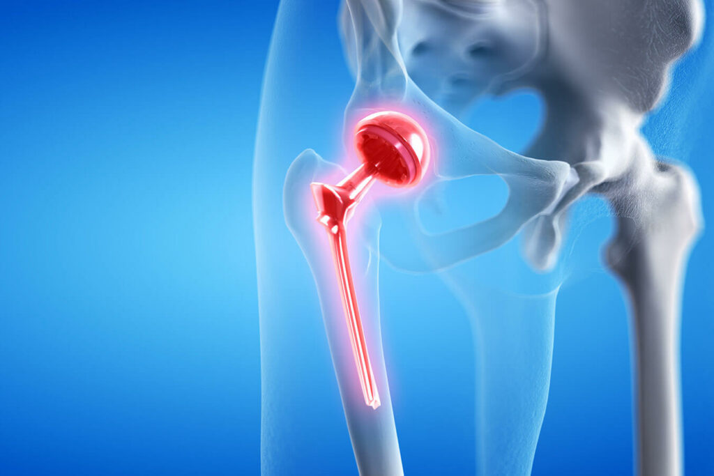 Protesi all’anca: quando riprendere con lo sport?
