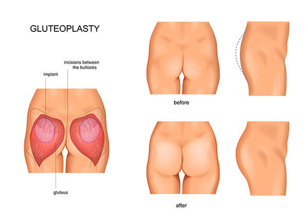 Come rassodare i glutei: l'importanza dell'allenamento