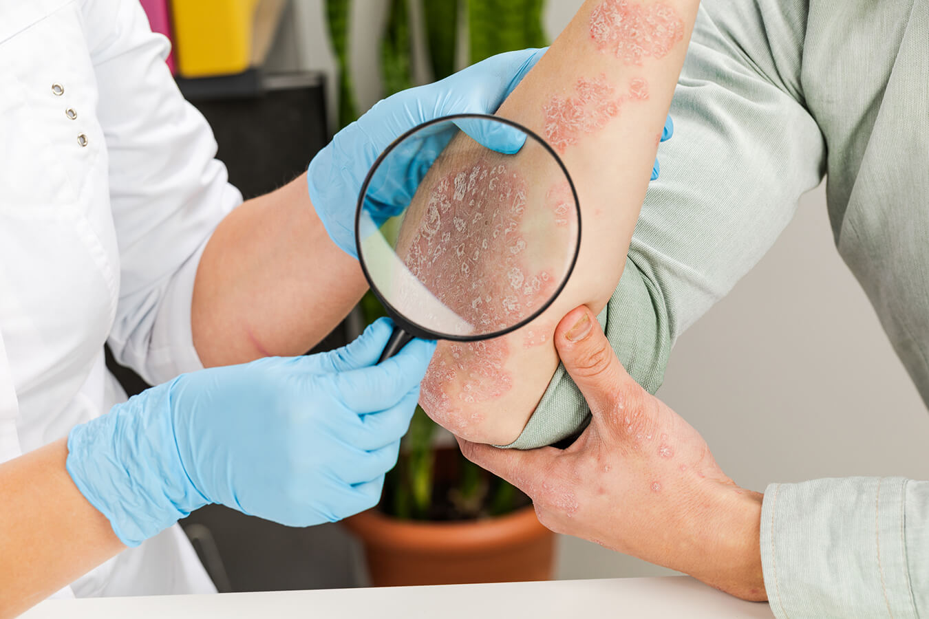 Psoriasi: la guida e i rimedi