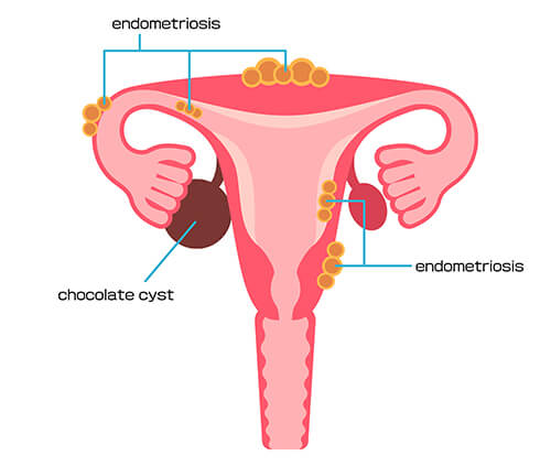 La gestione del dolore associato all'endometriosi