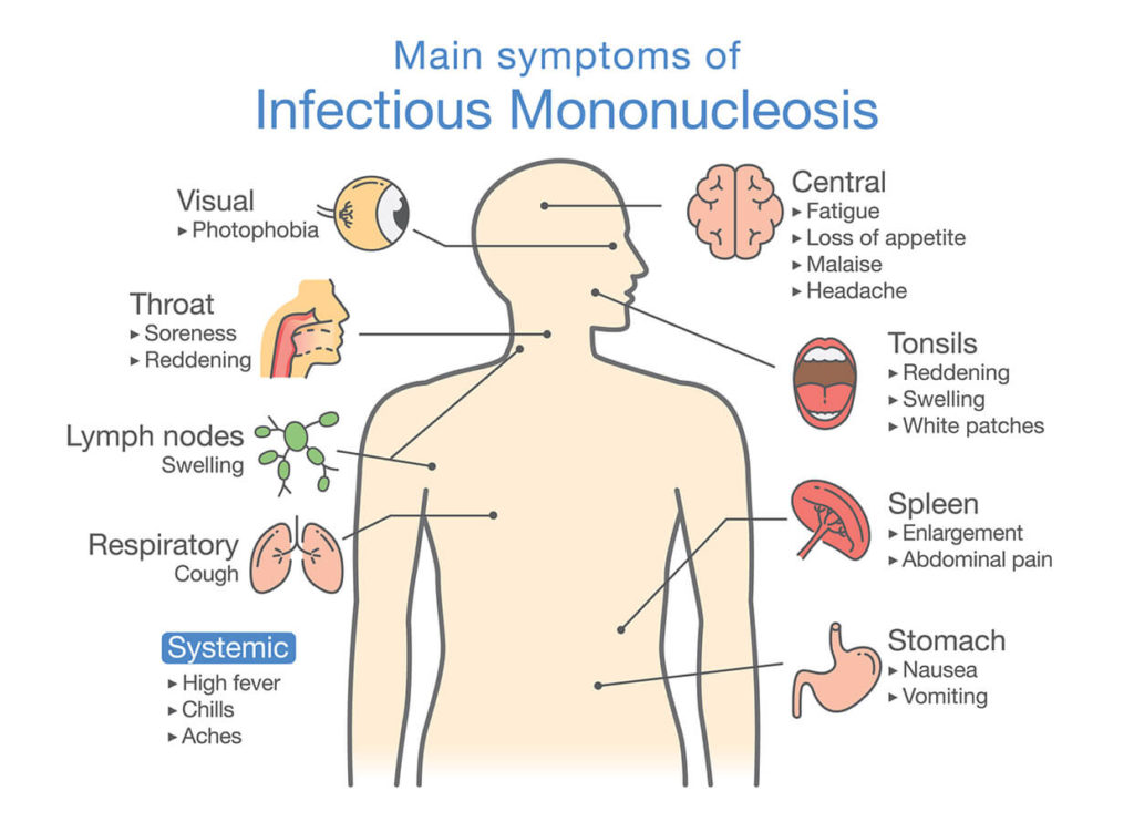 Diagnosi e terapia della mononucleosi: cosa fare?