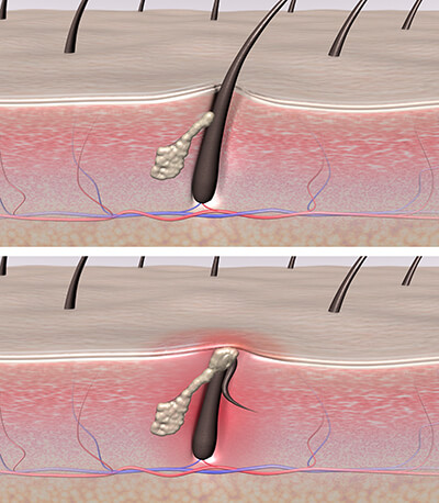 Rimedi naturali e prodotti cosmetici per eliminare i punti neri