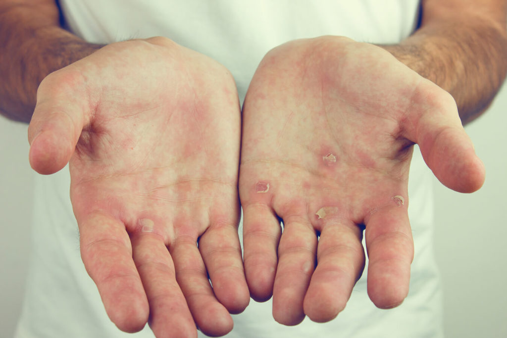 Cause scatenanti e fattori di rischio dei calli sulle mani