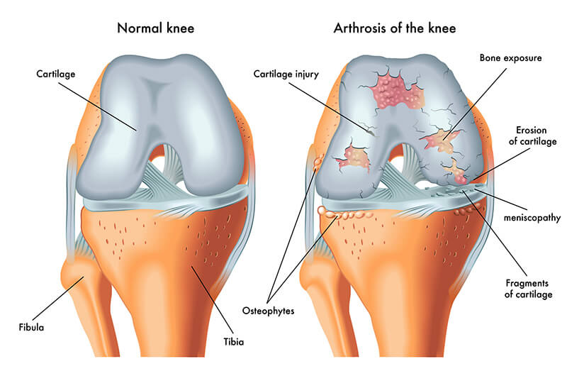Dove si trova la cartilagine nel nostro corpo e quali sono i tipi più comuni?