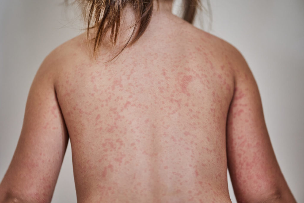 Durata dell'Orticaria da Stress