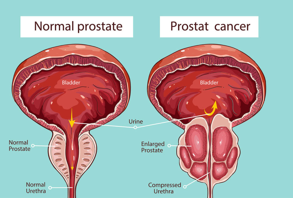 Cosa non fare con la prostata ingrossata?