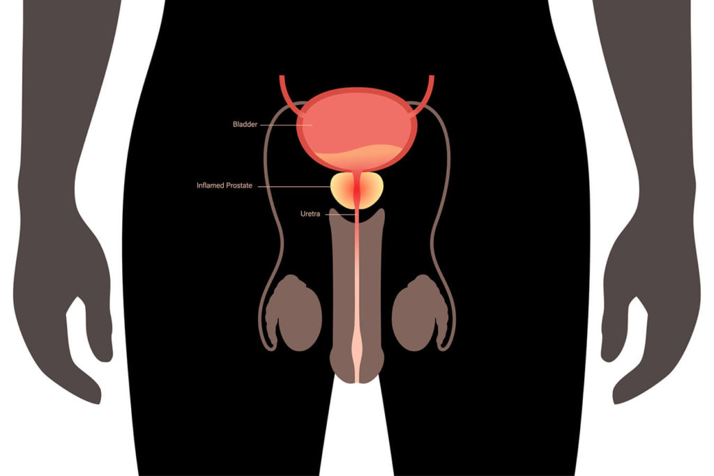 Prostata Ingrossata: Cause, Sintomi e Consigli Utili