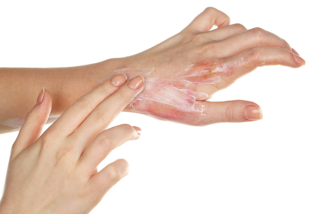 Creme e prodotti farmaceutici per le scottature