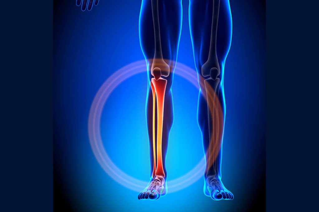 Tibia: Guida alle Lesioni e alla Guarigione