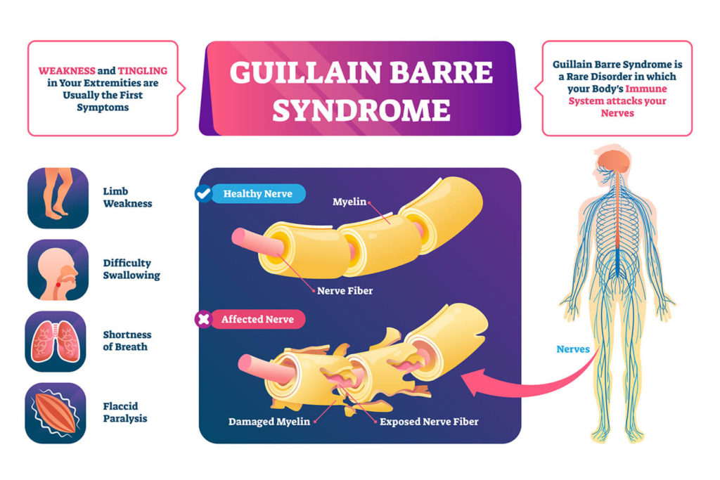 Come si Manifesta la Sindrome di Guillain-Barré