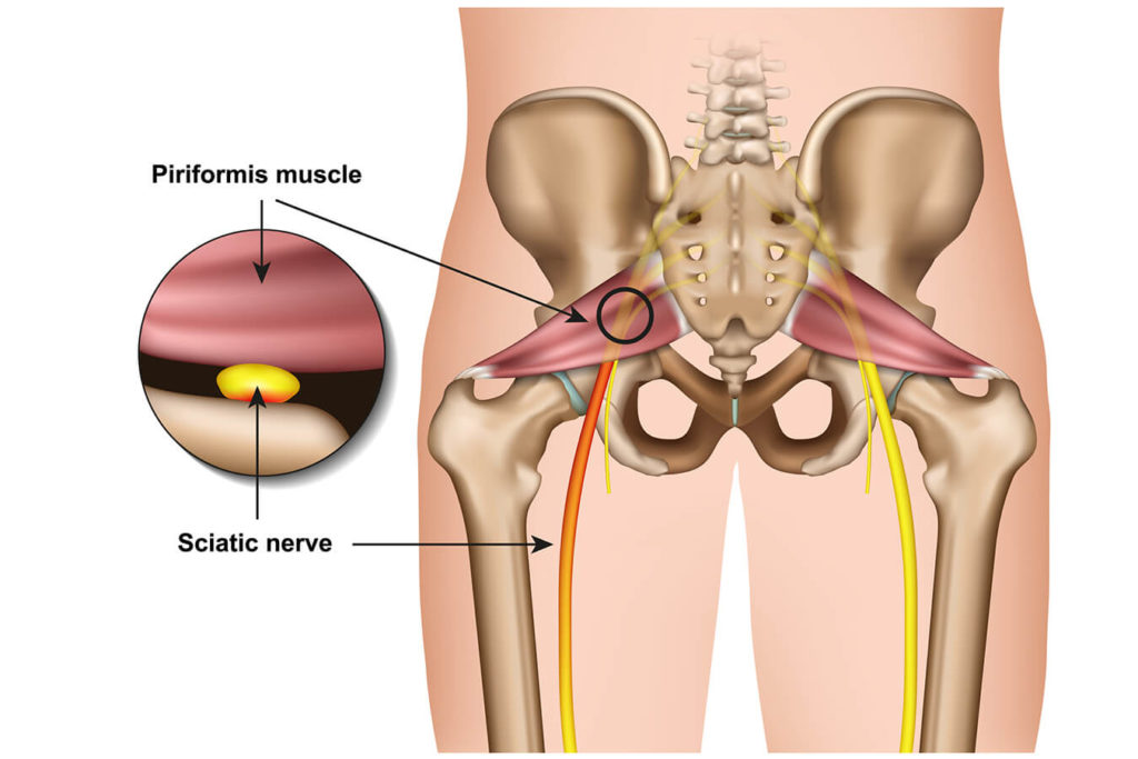 Muscolo piriforme: cause, sintomi e trattamenti
