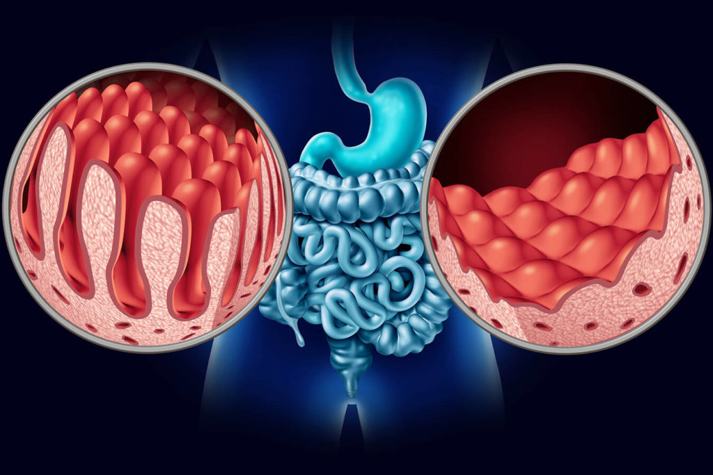 Celiachia: come riconoscere e gestire la malattia