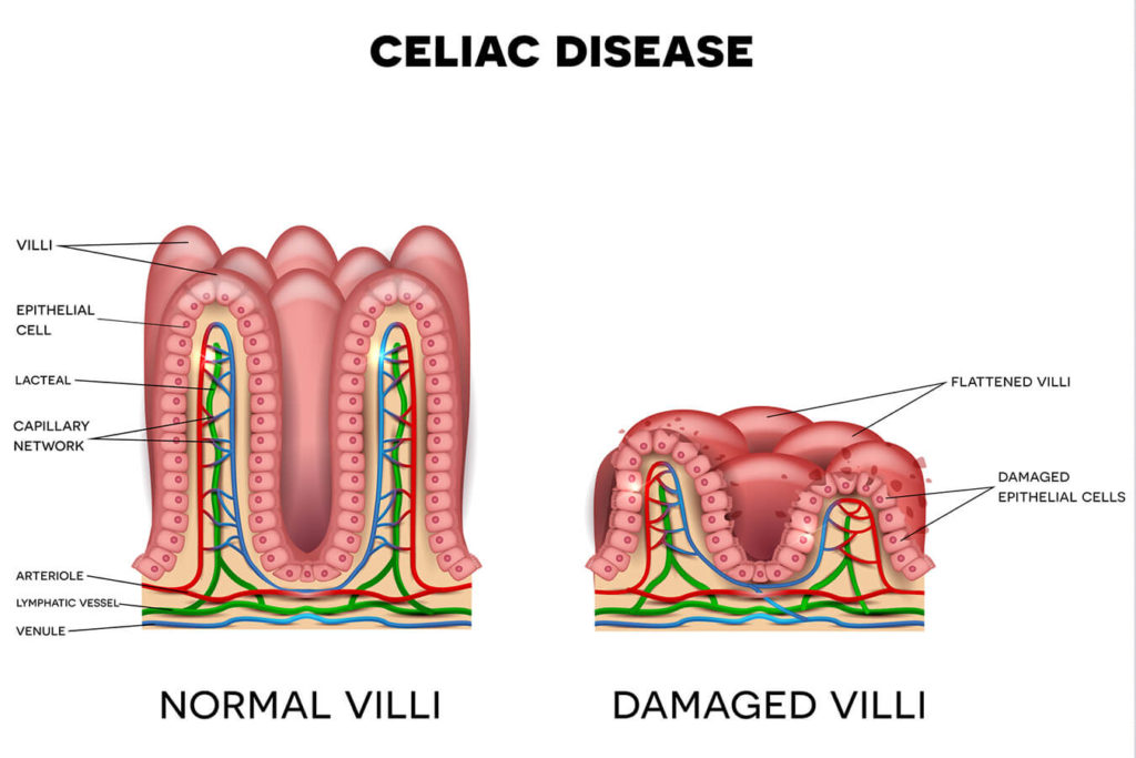 Cosa non si può mangiare se si è celiaci