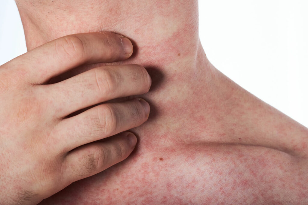 Allergie ai carboidrati: sintomi, cause e alimenti da evitare