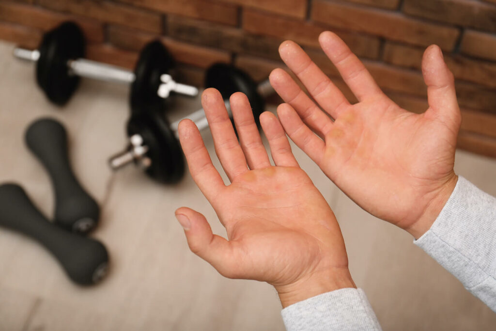 Calli alle Mani in Palestra ecco come prevenirli e trattarli