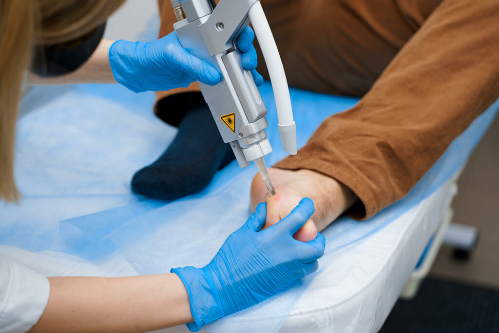 Come togliere le verruche: rimedi naturali e trattamenti medici