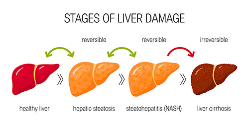 Sintomi del fegato grasso: come riconoscerlo