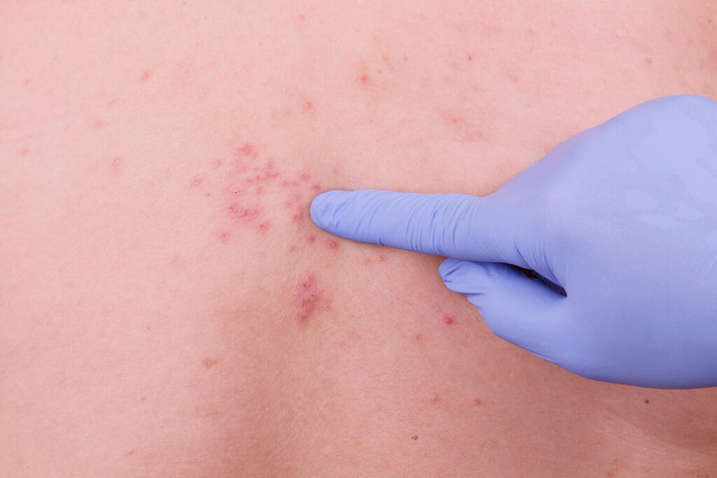 Fuoco di Sant Antonio: sintomi, cause e rimedi