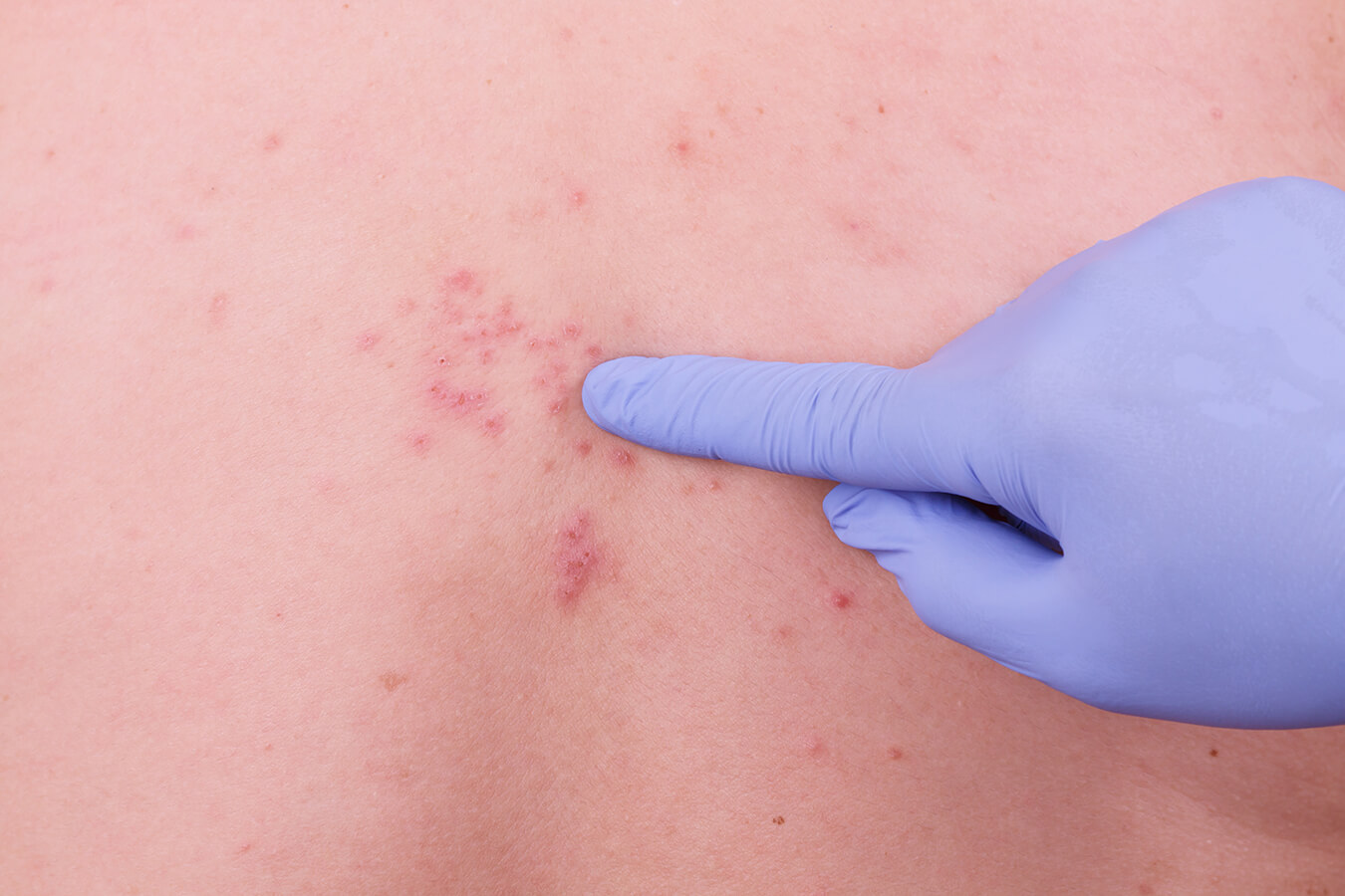 Fuoco di Sant Antonio: sintomi, cause e rimedi - La Palestra